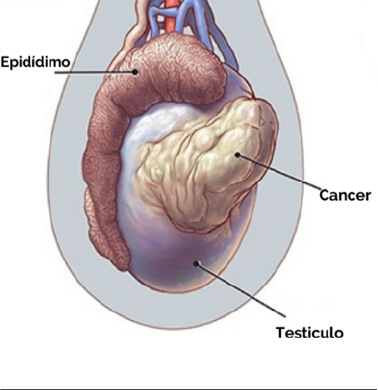 Câncer de Testículo - Dr. Matheus Siqueira